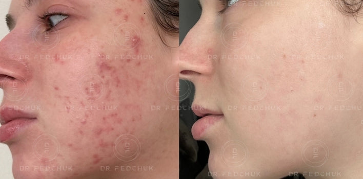 Radiance + Cell Renew Peeling System