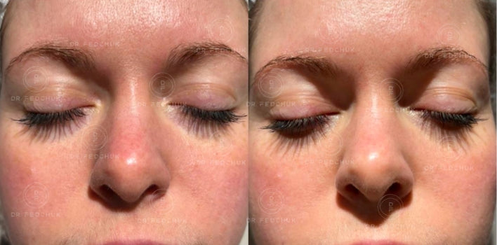 RESTRUCTA + CELL RENEW Peeling System