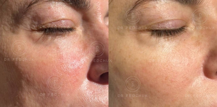 Restructa + Cell Renew Peeling System