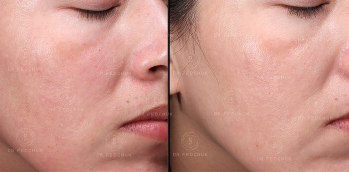 Skin Glow PURASOMES