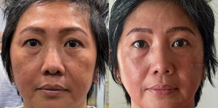 EXOPEEL