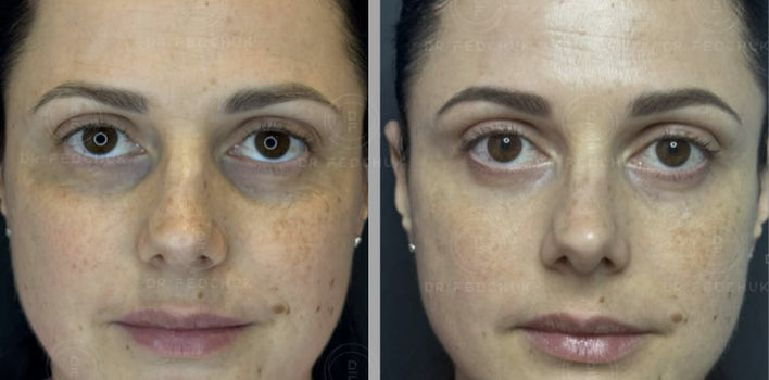 EXOPEEL