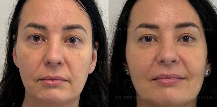 EXOPEEL | EXOLASER
