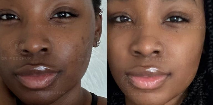 EXOPEEL