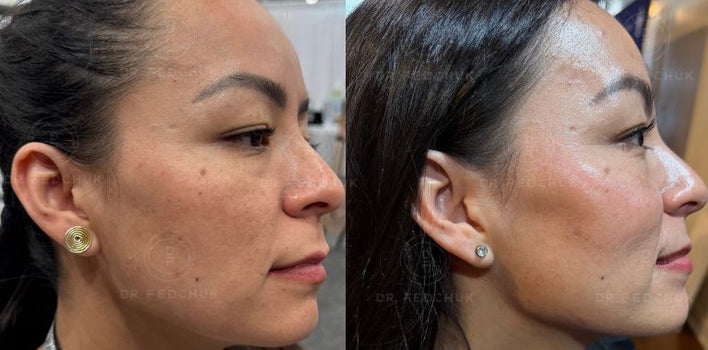 EXOPEEL