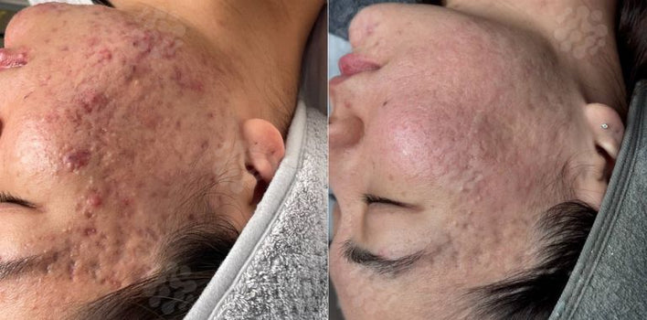 PEELING SYSTEM | EXOLASER