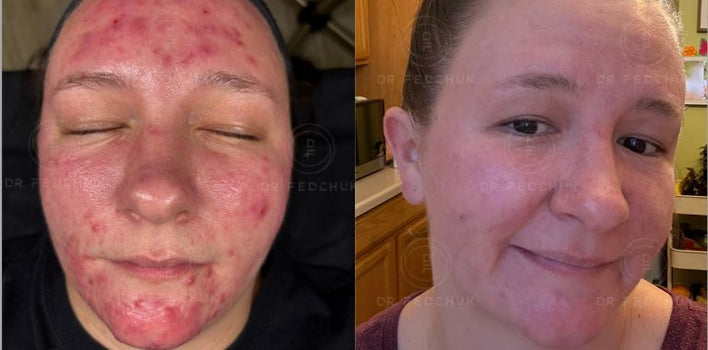 EXOPEEL