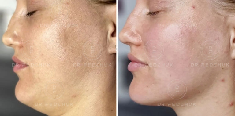 Before and after