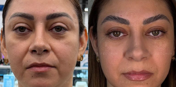 EXOPEEL