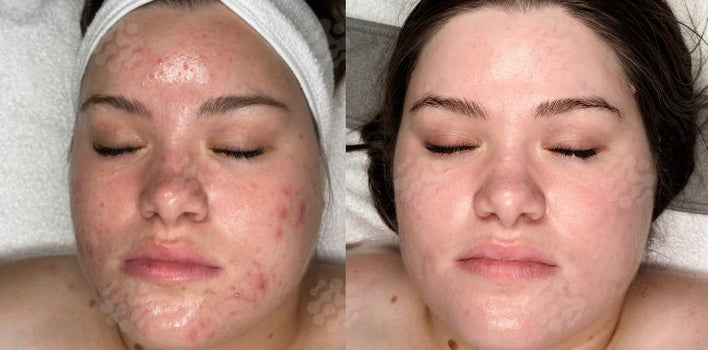 PEELING SYSTEM | PURASOMES | EXOLASER